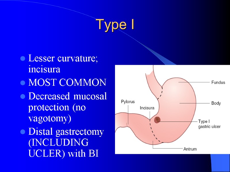 Type I Lesser curvature; incisura MOST COMMON Decreased mucosal protection (no vagotomy) Distal gastrectomy